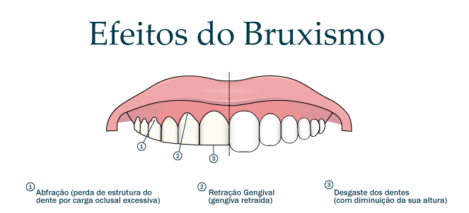bruxismo