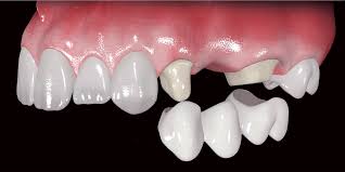 prot fixa ponte